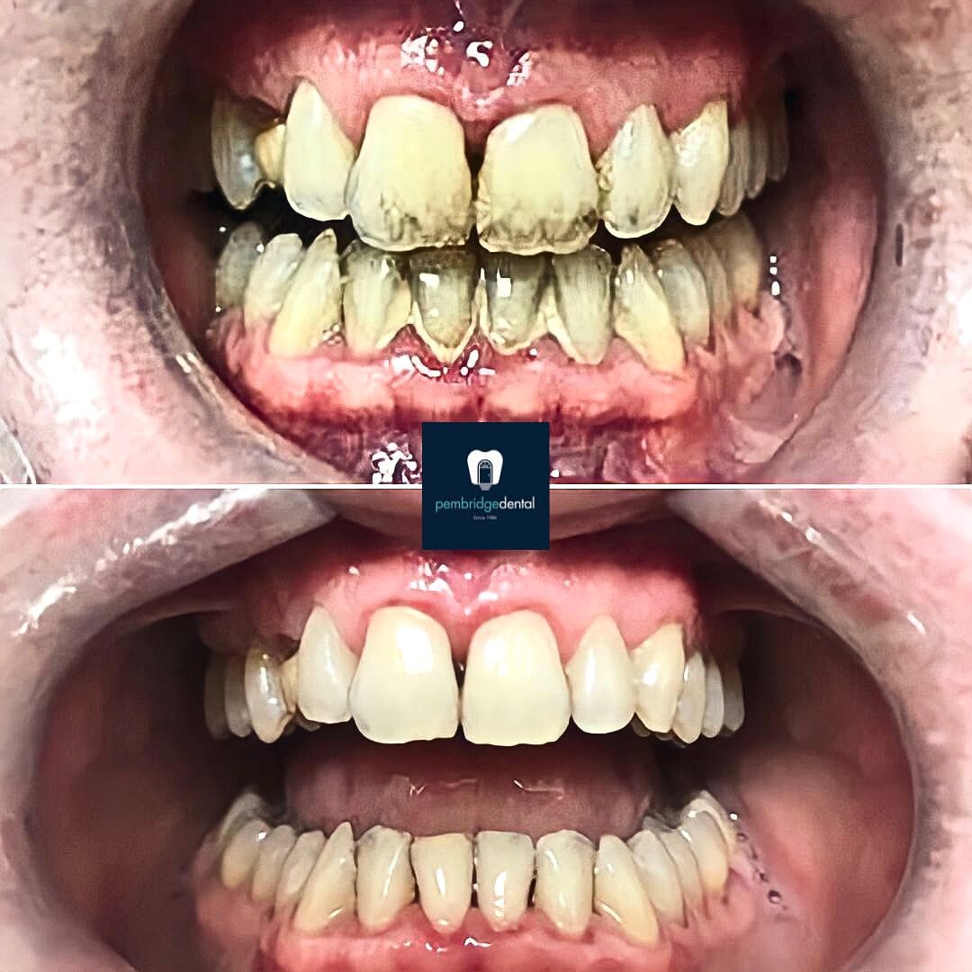 Patient smile transformation at Pembridge Dental