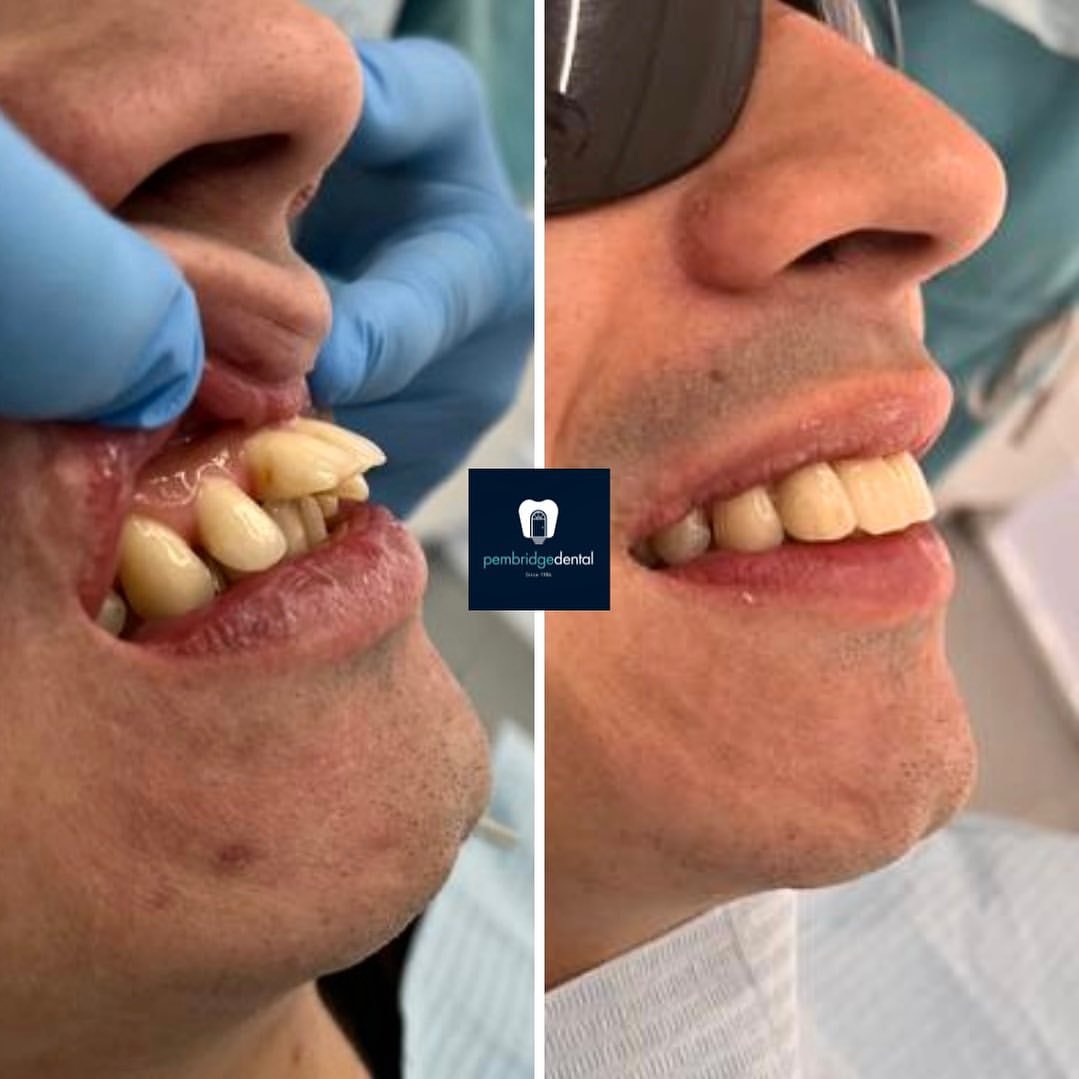 Smile makeover result at Pembridge Dental