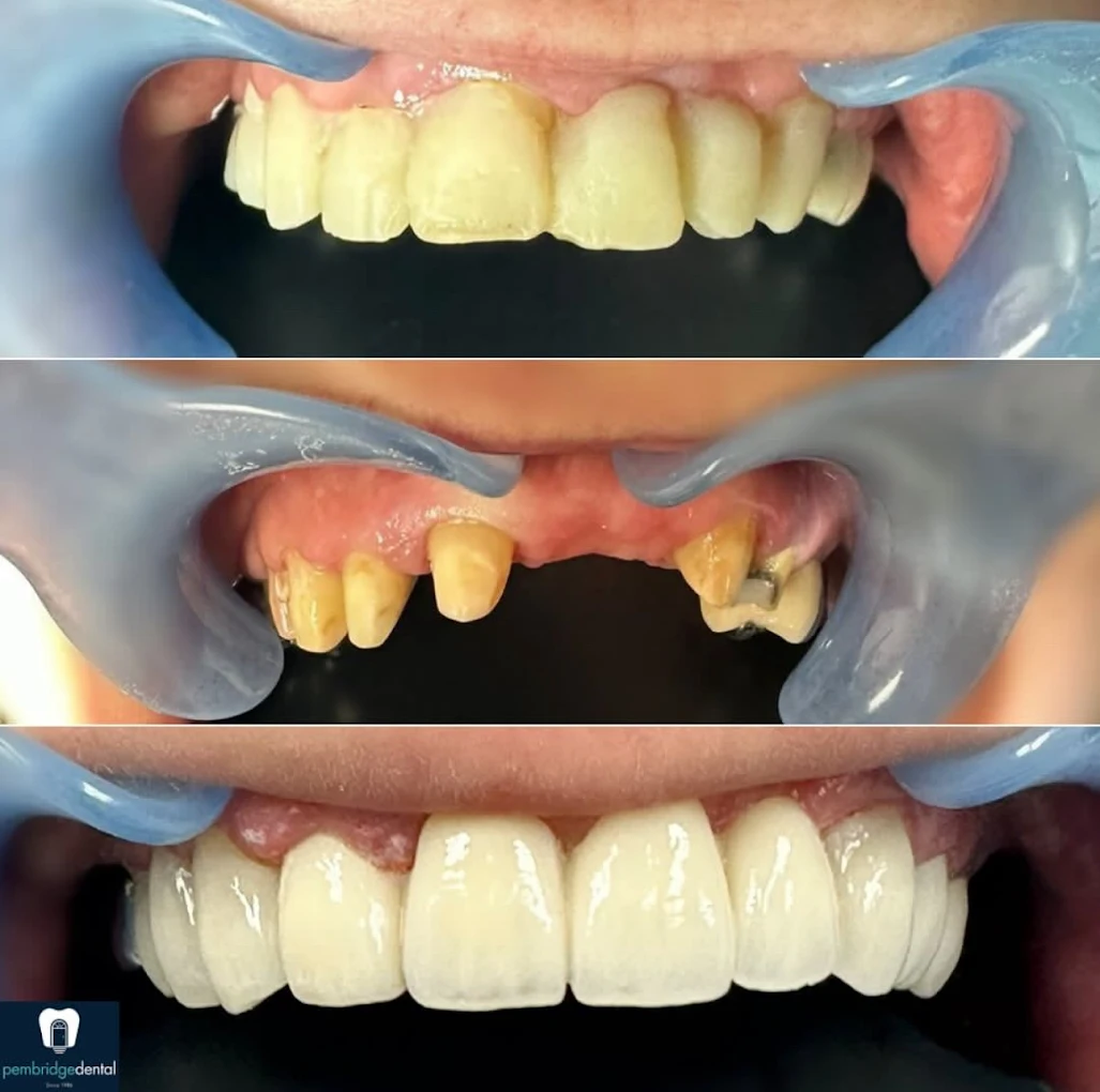 Dental treatment result at Pembridge Dental